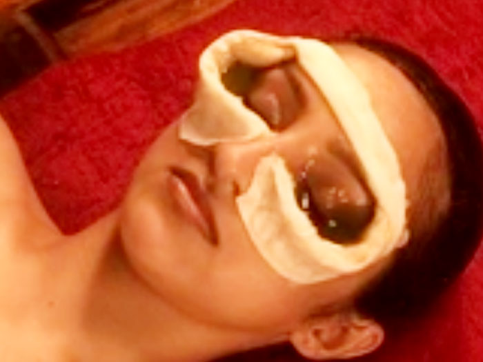 Netra Tharpanam ayurvedic treatment for eyes