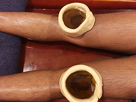 Januvasti - Ayurvedic Therapy Treatment for Chronic Knee Pain and Joint Pain